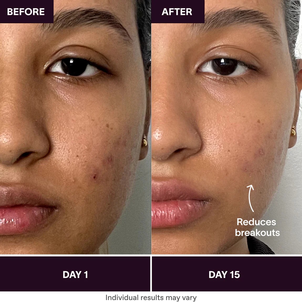 Ondaum World's Mini Acne Solution before and after result
